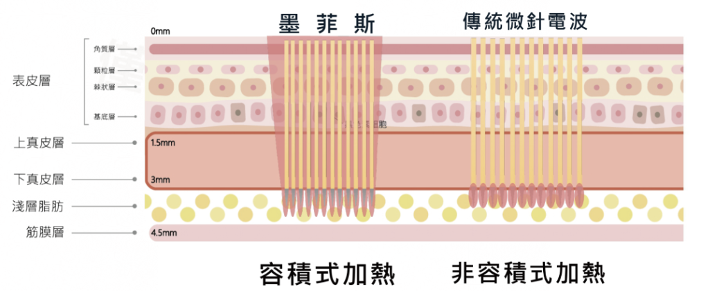 墨菲斯電波的原理:為何能同時緊緻、除皺又塑形?